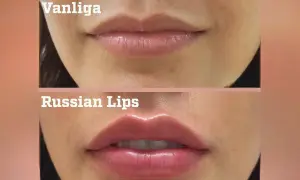 Före- och efterbilder på läppförstoring med fillers. Överläppen har fått en tydlig volymökning.
