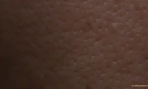 Närbild på hud med synliga, stora porer. Texturen visar små fördjupningar som ger ett mönster.