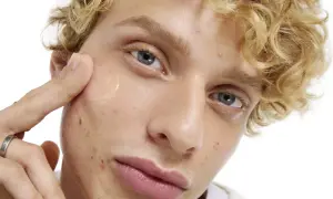 En ung man med lockigt blont hår applicerar en klar gel på kinden, en del av hans resa för att få clear skin.