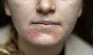 Närbild på en persons mun och haka med rodnad och utslag, tecken på perioral dermatit.