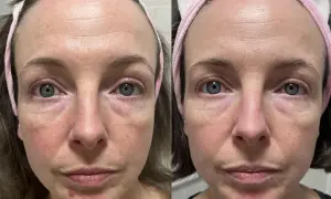 Före- och efterbilder av en kvinna med rosacea. Hudens rodnad och ojämnheter har minskat efter användning av niacinamid.
