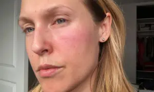 En kvinna med rodnad och små prickar på kinden, som kan vara allergiska utslag.