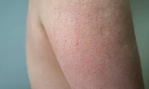 Närbild på hud med små röda prickar, typiskt för keratosis pilaris.