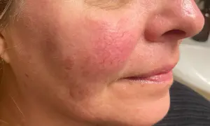 Närbild på en kvinnas kind med synliga röda blodkärl, ett tecken på rosacea. Bilden visar effekten av en rosacea behandling.