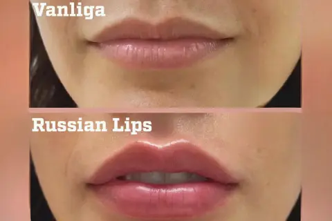 Före- och efterbilder på läppförstoring med fillers. Överläppen har fått en tydlig volymökning.