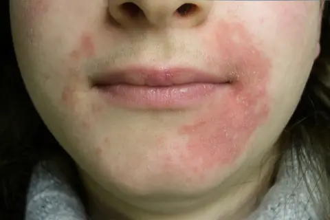 Röd, flagnande hud runt munnen, troligen perioral dermatit orsakad av stress.