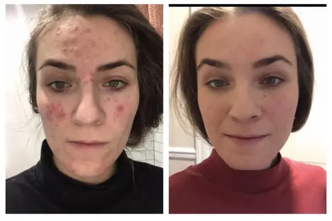 Före- och efterbilder på en kvinna med akne. Efter behandling med azelainsyra syns en markant förbättring av hudens tillstånd.