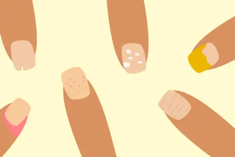 Illustration av naglar med olika problem som kan tyda på zinkbrist: fläckar, sprickor och missfärgningar.