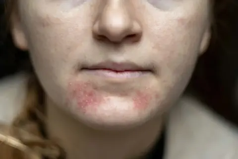 Närbild på en persons mun och haka med rodnad och utslag, tecken på perioral dermatit.