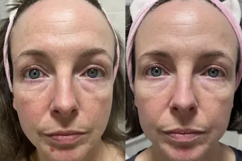 Före- och efterbilder av en kvinna med rosacea. Hudens rodnad och ojämnheter har minskat efter användning av niacinamid.