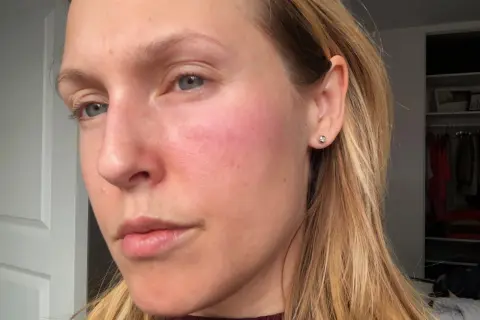 En kvinna med rodnad och små prickar på kinden, som kan vara allergiska utslag.