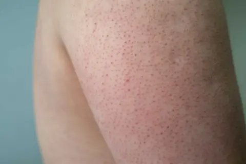 Närbild på hud med små röda prickar, typiskt för keratosis pilaris.