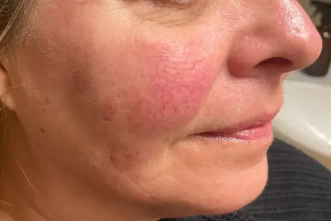 Närbild på en kvinnas kind med synliga röda blodkärl, ett tecken på rosacea. Bilden visar effekten av en rosacea behandling.