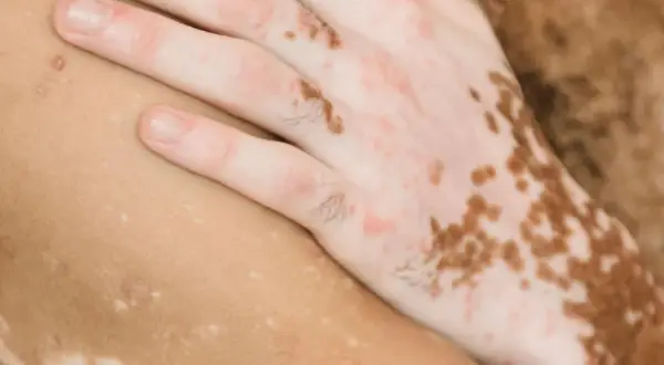 Närbild på en hand och arm med vitiligo, där vita prickar på huden skapar ett unikt mönster.