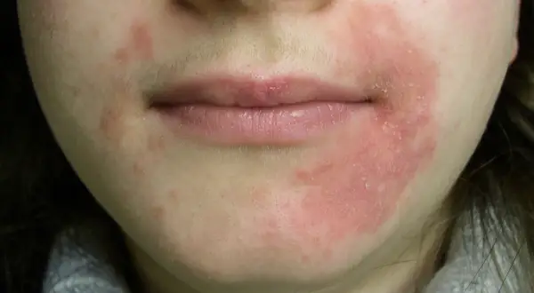 Röd, flagnande hud runt munnen, troligen perioral dermatit orsakad av stress.