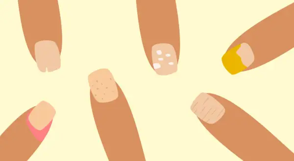 Illustration av naglar med olika problem som kan tyda på zinkbrist: fläckar, sprickor och missfärgningar.