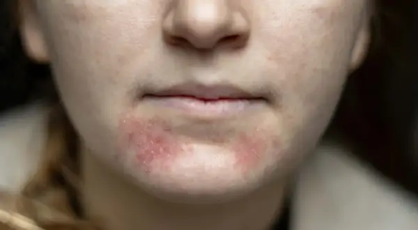 Närbild på en persons mun och haka med rodnad och utslag, tecken på perioral dermatit.