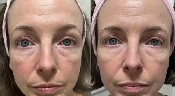 Före- och efterbilder av en kvinna med rosacea. Hudens rodnad och ojämnheter har minskat efter användning av niacinamid.