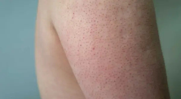 Närbild på hud med små röda prickar, typiskt för keratosis pilaris.