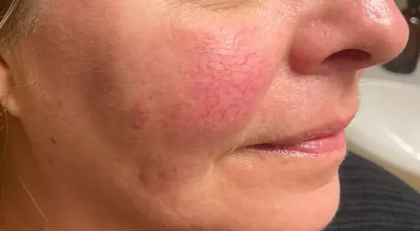Närbild på en kvinnas kind med synliga röda blodkärl, ett tecken på rosacea. Bilden visar effekten av en rosacea behandling.