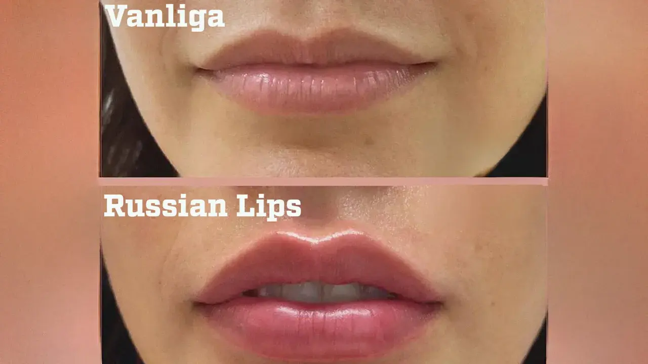 Före- och efterbilder på läppförstoring med fillers. Överläppen har fått en tydlig volymökning.