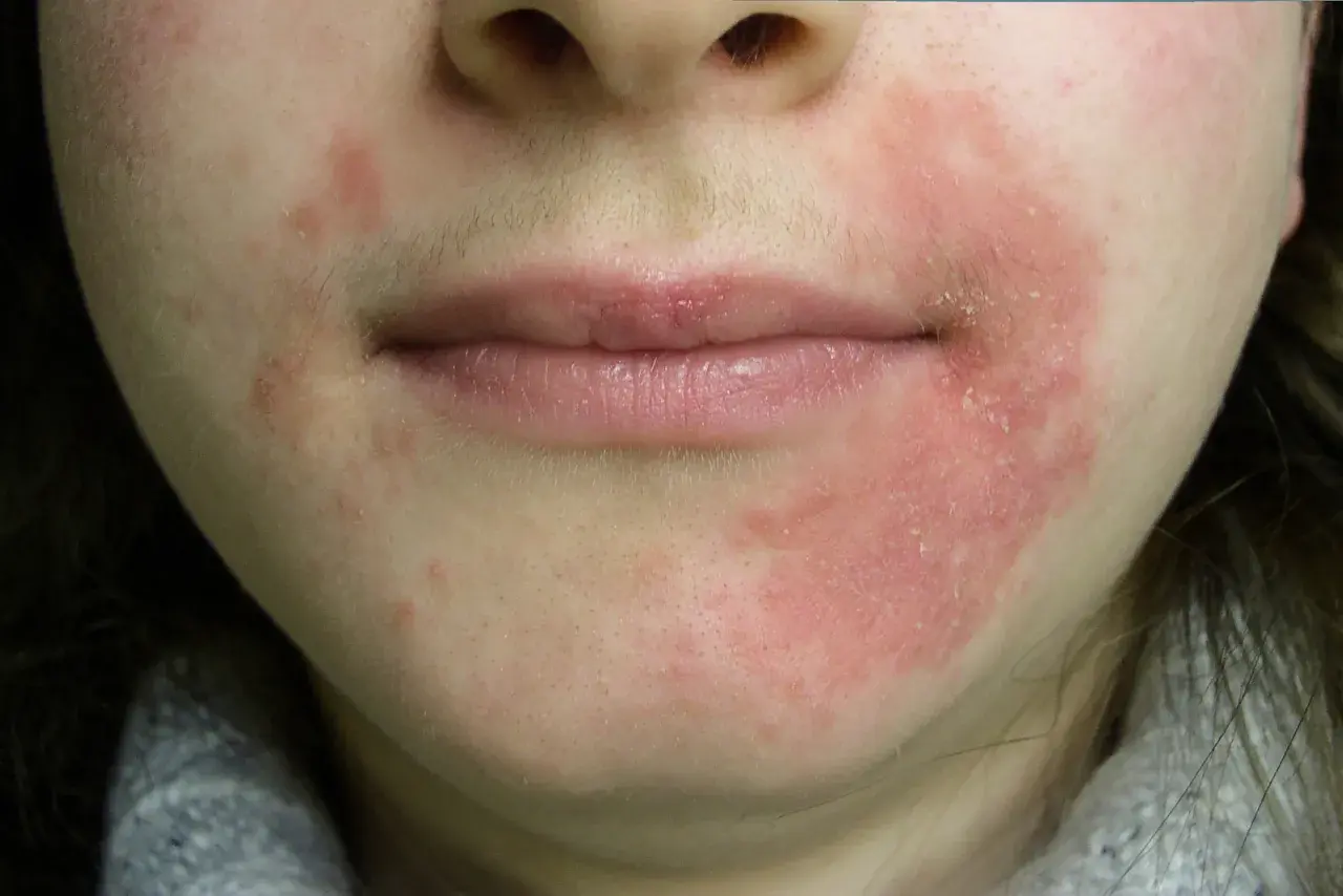Röd, flagnande hud runt munnen, troligen perioral dermatit orsakad av stress.
