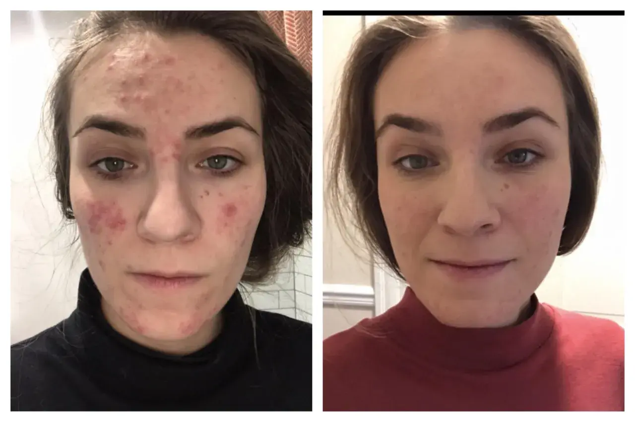 Före- och efterbilder på en kvinna med akne. Efter behandling med azelainsyra syns en markant förbättring av hudens tillstånd.