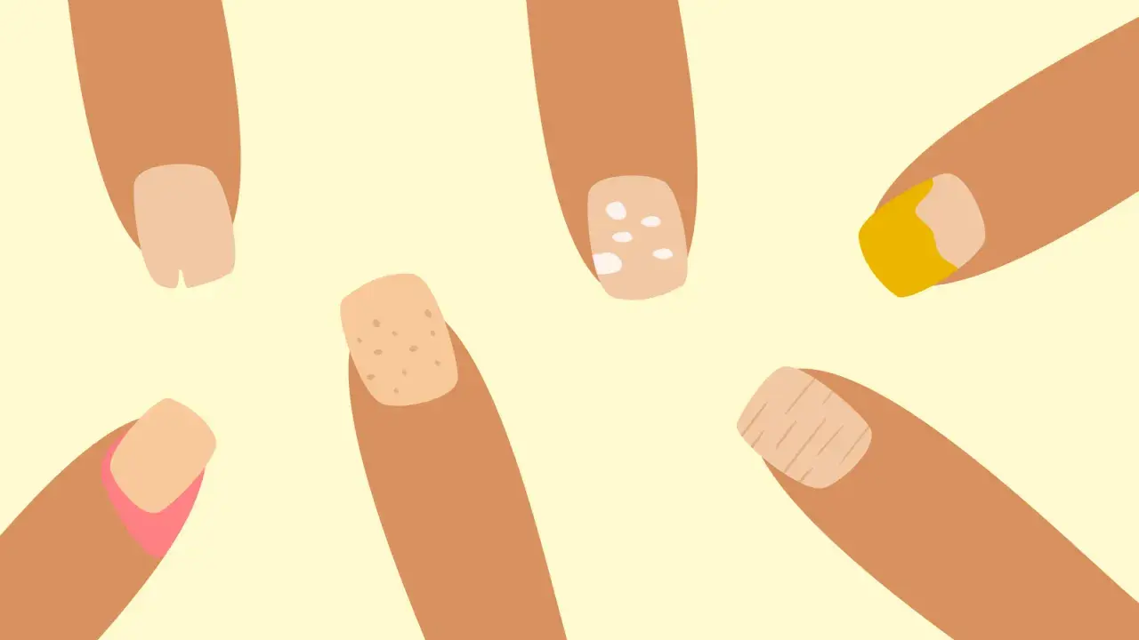 Illustration av naglar med olika problem som kan tyda på zinkbrist: fläckar, sprickor och missfärgningar.