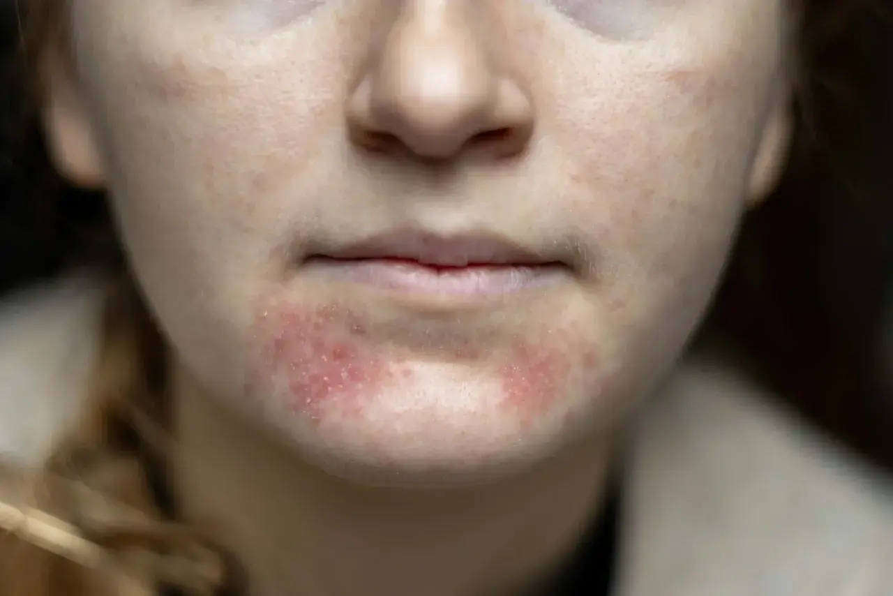 Närbild på en persons mun och haka med rodnad och utslag, tecken på perioral dermatit.