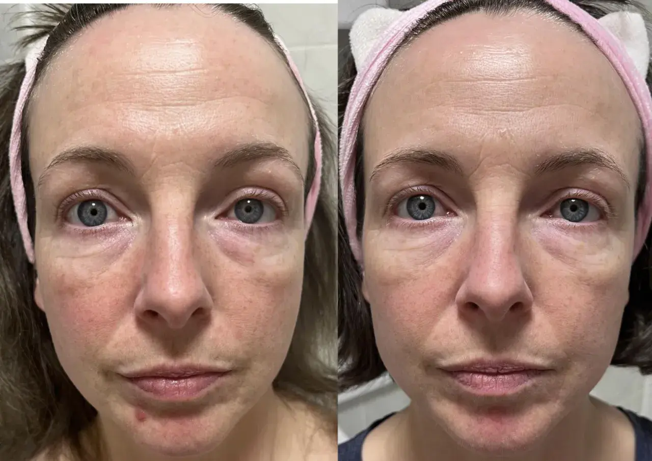 Före- och efterbilder av en kvinna med rosacea. Hudens rodnad och ojämnheter har minskat efter användning av niacinamid.