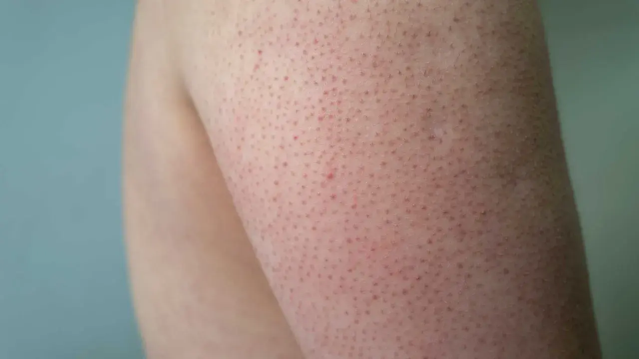 Närbild på hud med små röda prickar, typiskt för keratosis pilaris.