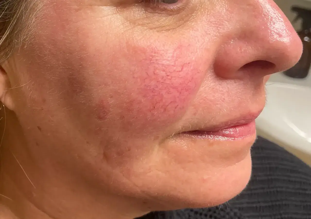 Närbild på en kvinnas kind med synliga röda blodkärl, ett tecken på rosacea. Bilden visar effekten av en rosacea behandling.