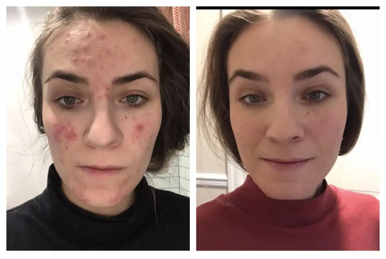 Före- och efterbilder på en kvinna med akne. Efter behandling med azelainsyra syns en markant förbättring av hudens tillstånd.
