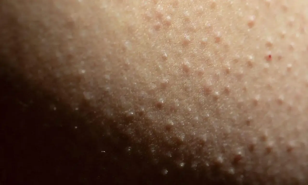 Närbild på hud med små upphöjningar, typiskt för keratosis pilaris.