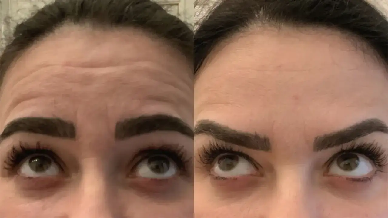F&ouml;re- och efterbilder visar en sl&auml;tare panna efter h&aring;rbotox.