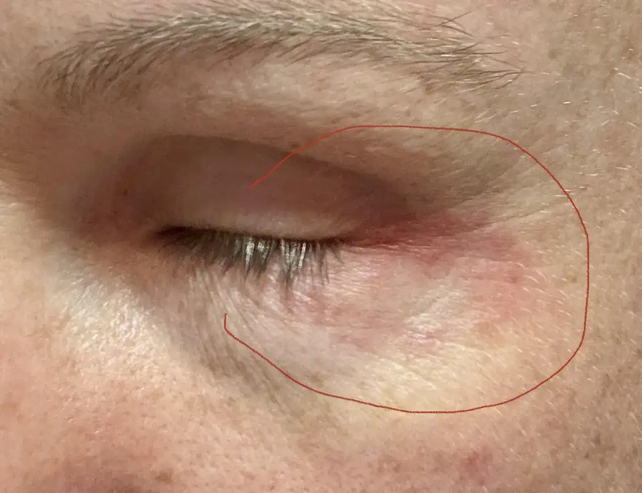 Rodnad och irritation runt ögat, troligen periorbital dermatit. Huden är röd och lite svullen.
