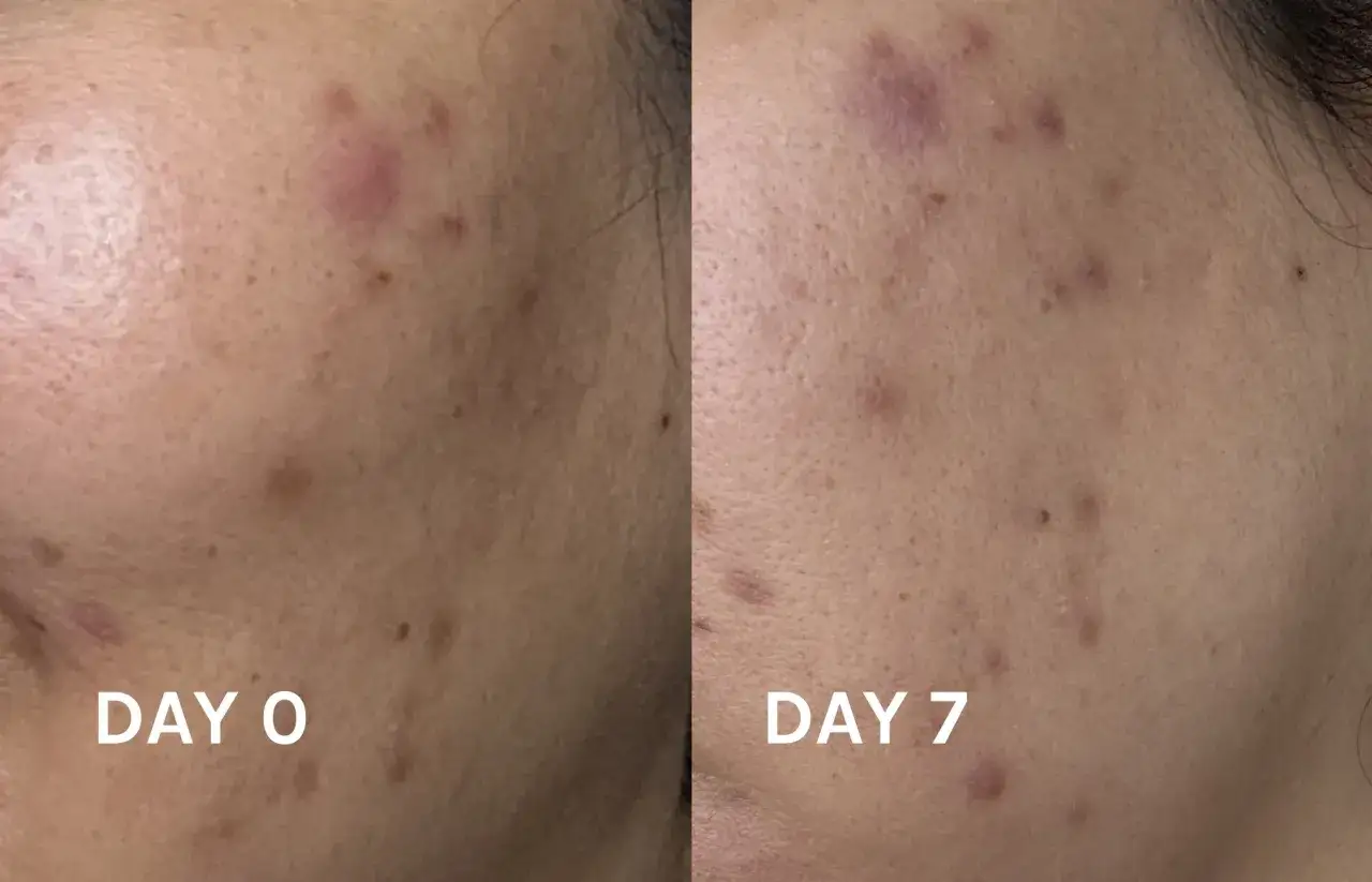 Före och efter bilder visar tydliga epiduo resultat på akne efter 7 dagar.