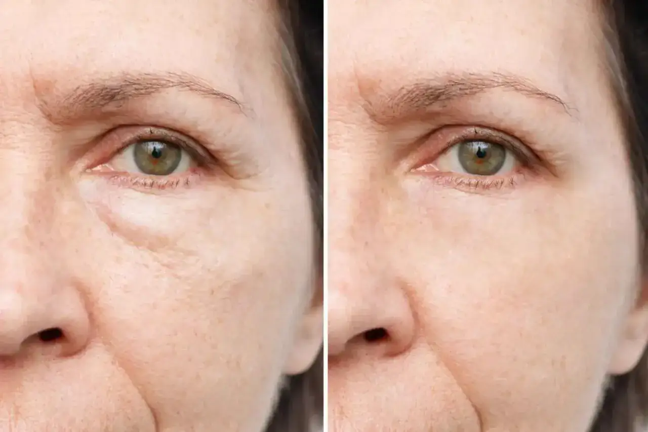 F&ouml;re och efter bilder visar en kvinna som njuter av solen efter botox. Rynkor runt &ouml;gonen har minskat.