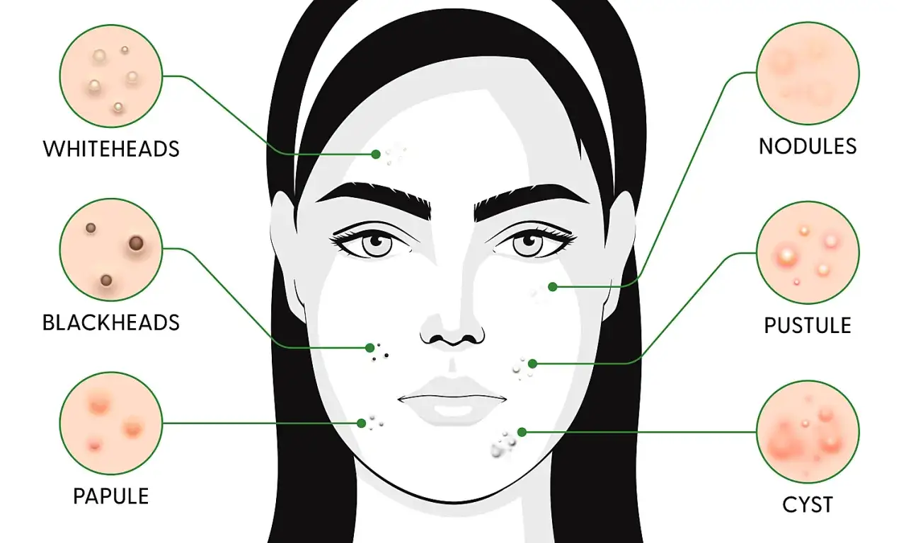 Illustration av olika typer av finnar: whiteheads, blackheads, papules, pustules, nodules och cystor. Undvik att trycka finnar f&ouml;r att f&ouml;rhindra &auml;rrbildning.