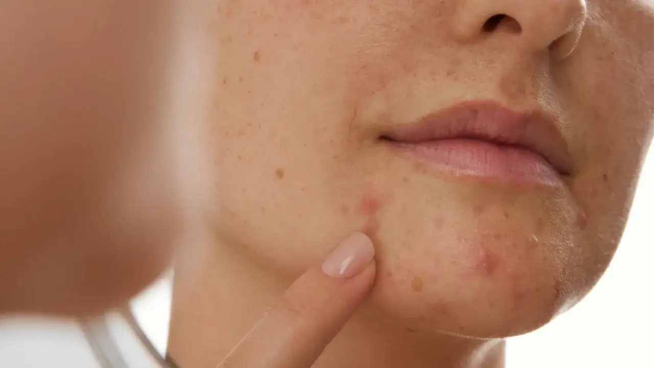 Närbild på en persons haka och mun, med en finger som pekar på en finne. Huden har flera små fläckar och rodnader, vilket kan vara tecken på hormonell akne.