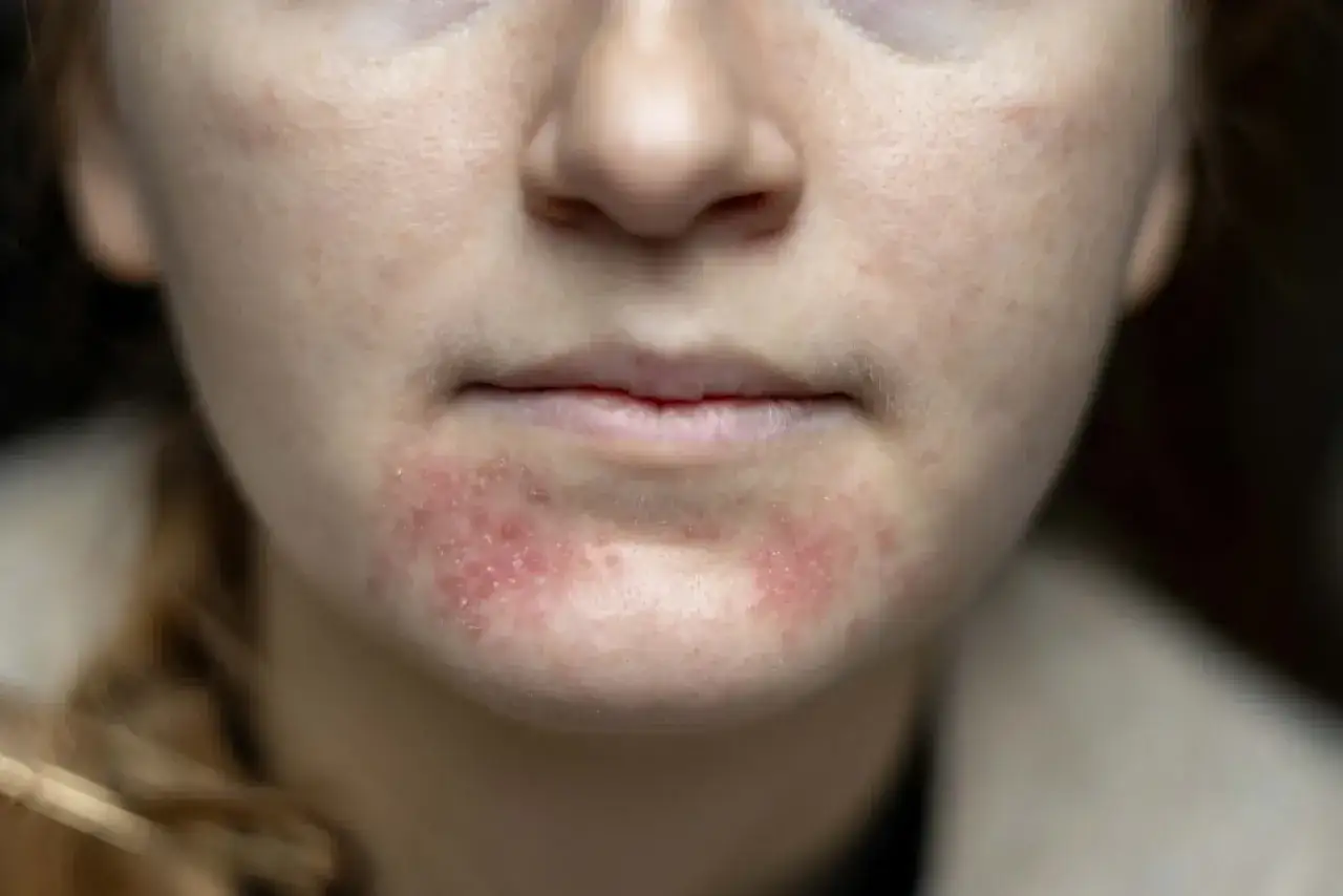 Närbild på en persons mun och haka med rodnad och utslag, tecken på perioral dermatit.