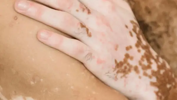 Närbild på en hand och arm med vitiligo, där vita prickar på huden skapar ett unikt mönster.
