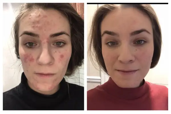 Före- och efterbilder på en kvinna med akne. Efter behandling med azelainsyra syns en markant förbättring av hudens tillstånd.