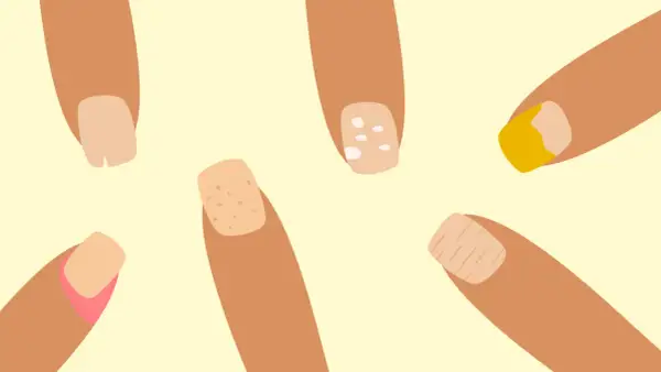 Illustration av naglar med olika problem som kan tyda på zinkbrist: fläckar, sprickor och missfärgningar.