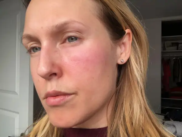 En kvinna med rodnad och små prickar på kinden, som kan vara allergiska utslag.
