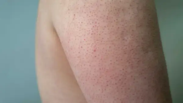 Närbild på hud med små röda prickar, typiskt för keratosis pilaris.